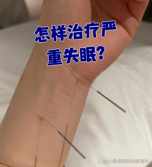 董氏针灸治失眠特效针