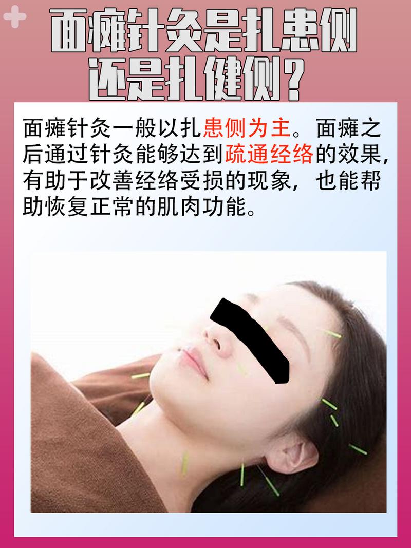 面瘫针灸健侧还是患侧