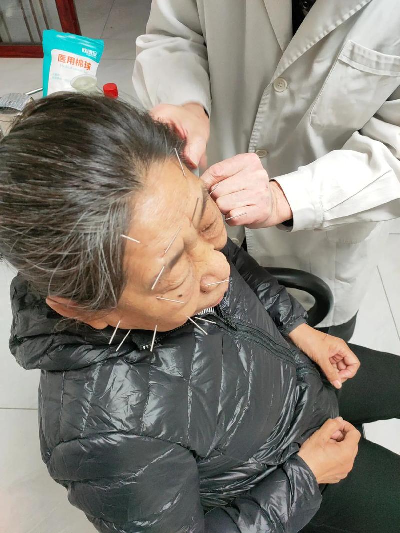 面神经炎针灸治疗图谱