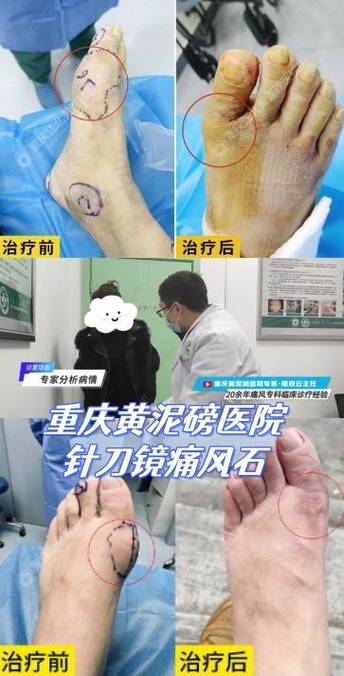 重庆治疗痛风九五专注