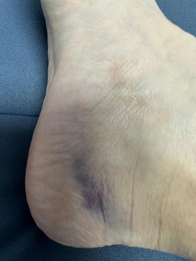 针灸后出现淤青正常吗