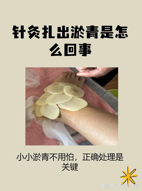 针灸后出现淤青正常吗