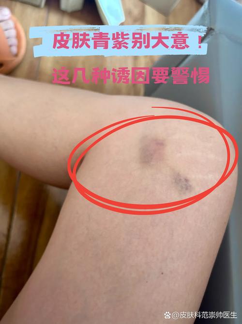 针灸后出现淤青正常吗