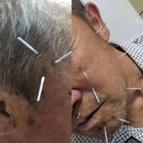 面肌痉挛针灸效果好吗