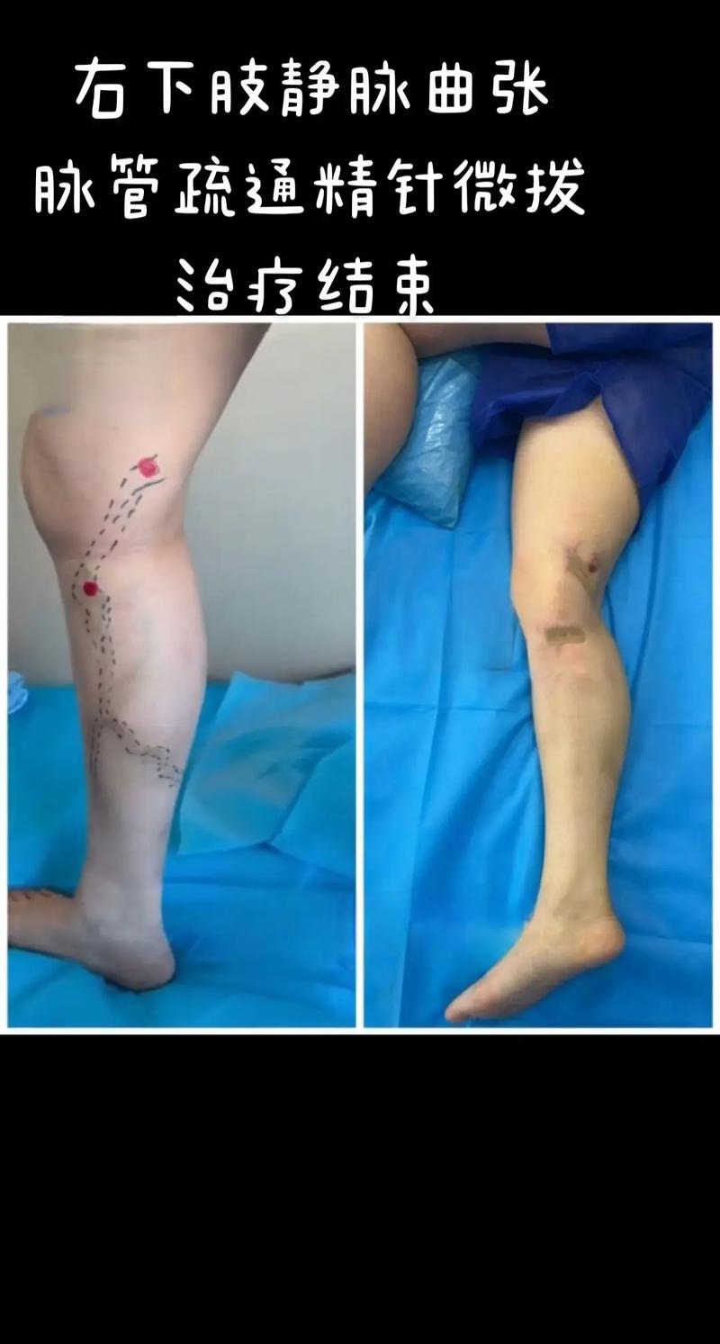 针灸治疗静脉曲张案例