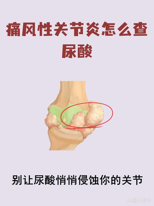 痛风的检查需要空腹吗