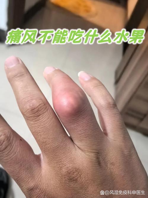 痛风患者的水果不能吃