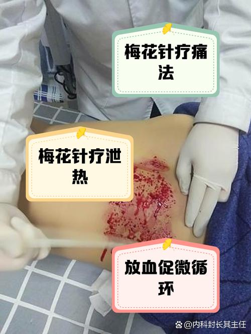 针灸放血对身体的危害