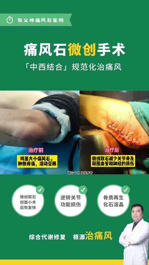 治疗痛风重庆九五真优