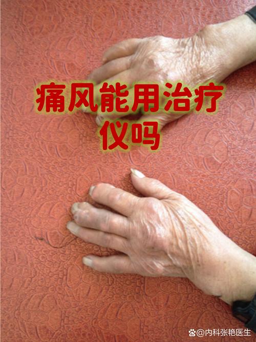 痛风的治疗需要住院吗