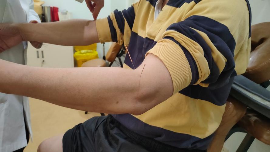 针灸治疗胃病能去根吗