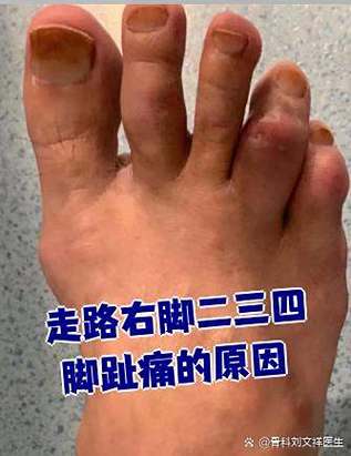 痛风右脚好了左脚就痛
