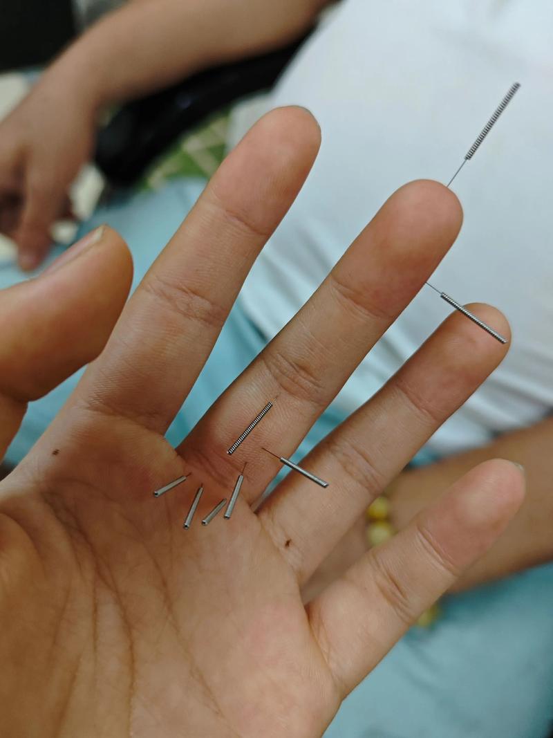 针灸不孕不育成功案例