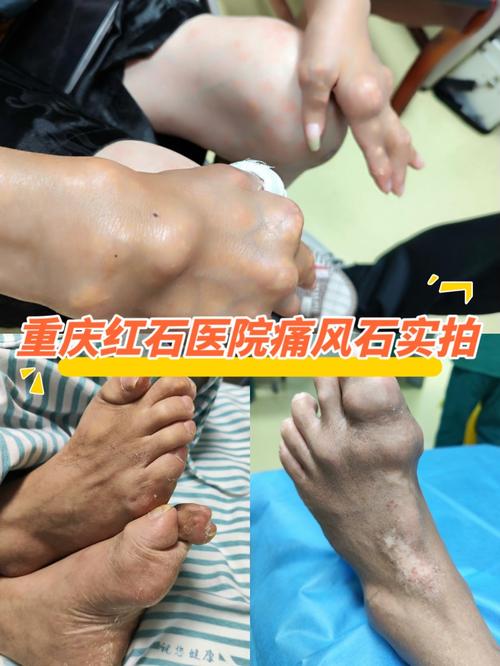 重庆治疗痛风九五真优