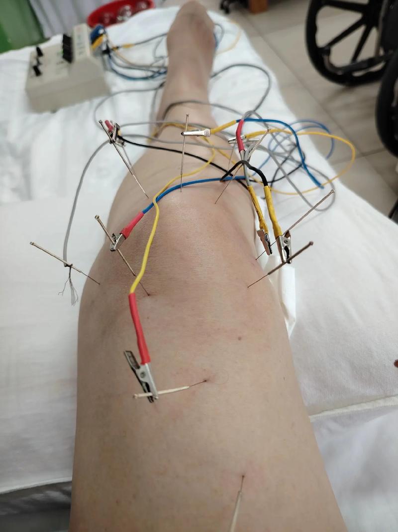 针灸完烤电治疗哪些病