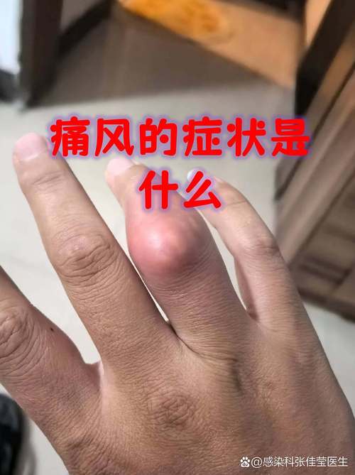 痛风早期的症状是什么