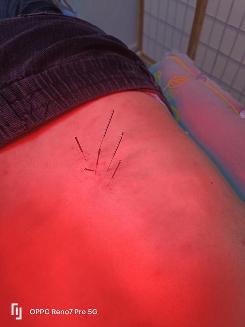 来月经可以针灸腰部吗