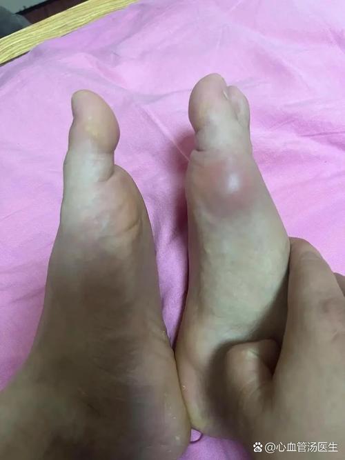 女性痛风初期症状图片