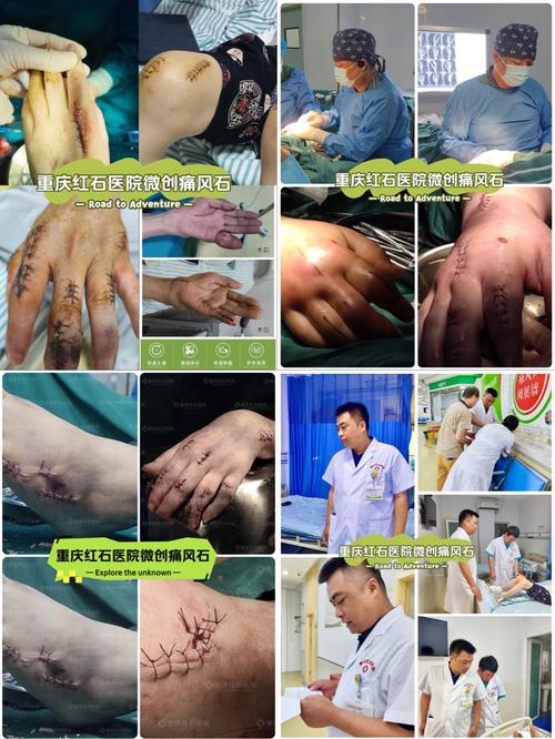 重庆治疗痛风九五直选