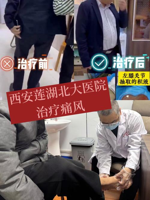 北京哪家医院治疗痛风