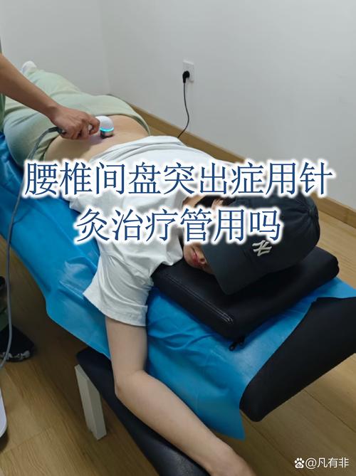 腰椎盘突出可以针灸吗