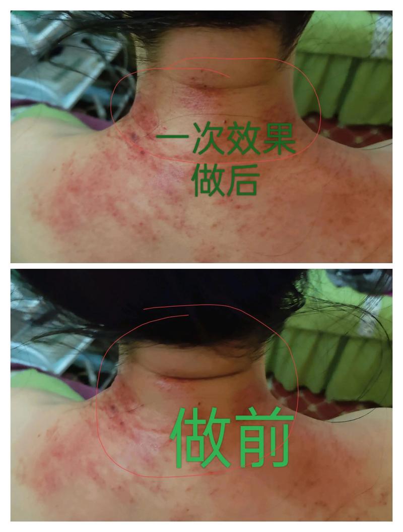 富贵包可以针灸消除吗