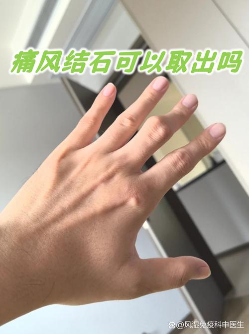 痛风结晶怎么可以化解