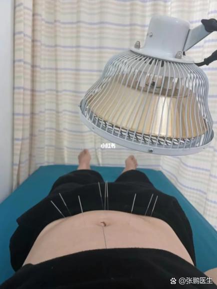 针灸治疗多囊卵巢图片