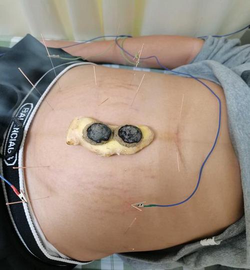 针灸治疗多囊卵巢图片