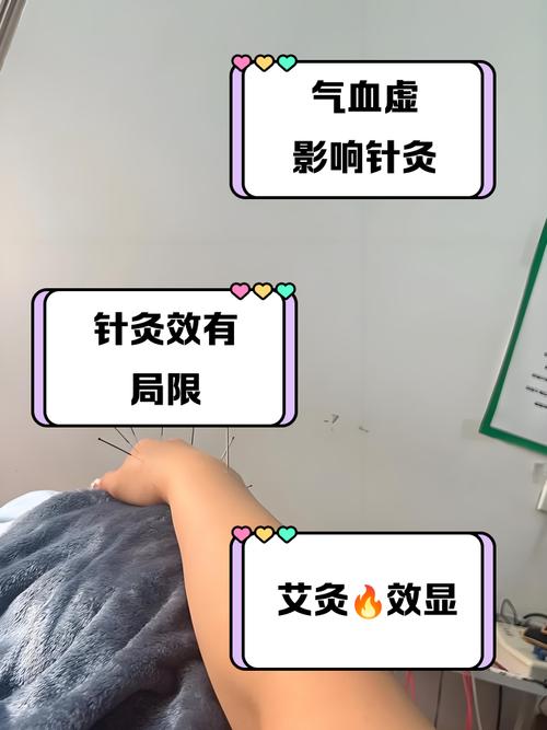 艾灸跟针灸哪个效果好