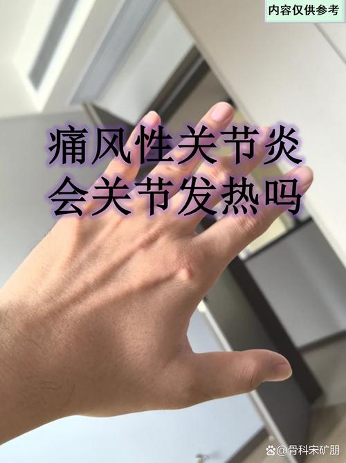苏州痛风性关节炎治疗