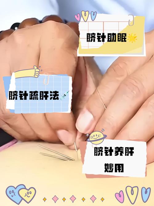 岔气针灸怎么治疗方法