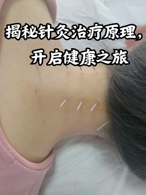 针灸能彻底治好疾病吗