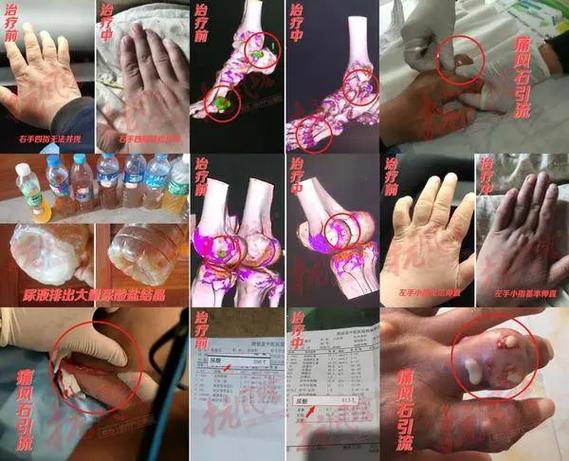 痛风 东北雌性红萝卜