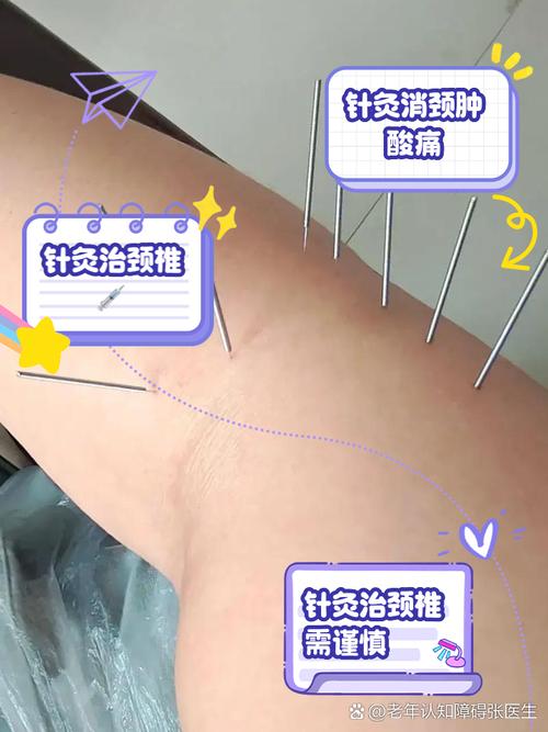 针灸多了对身体有害吗