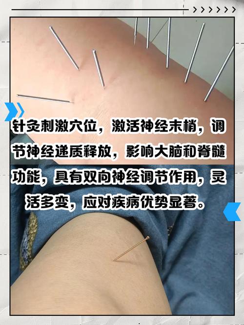 针灸能除去体内湿气吗