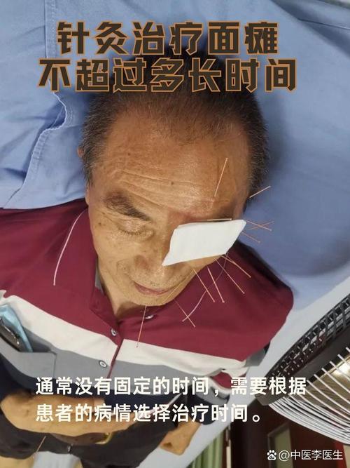 面瘫要针灸多久才能好