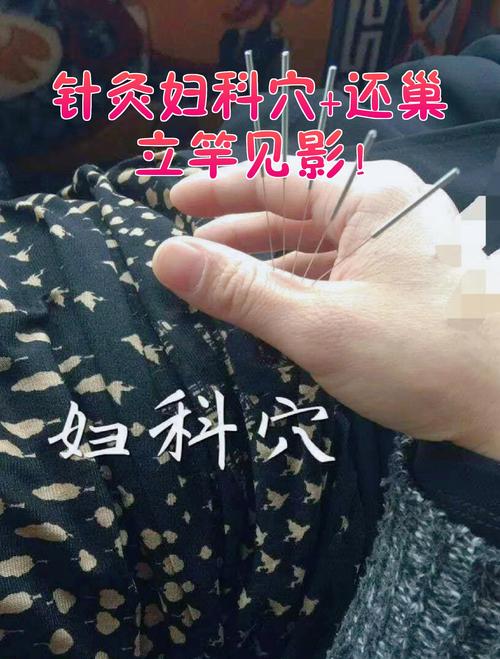 产后风可以针灸治疗吗