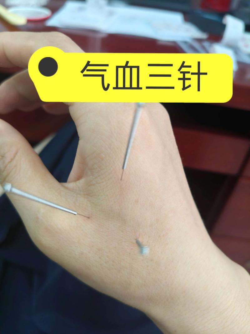 气血不足针灸效果好吗