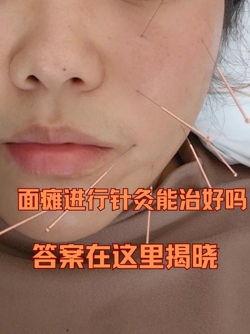 面瘫来月经可以针灸吗