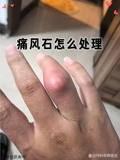 痛风有了痛风石怎么办