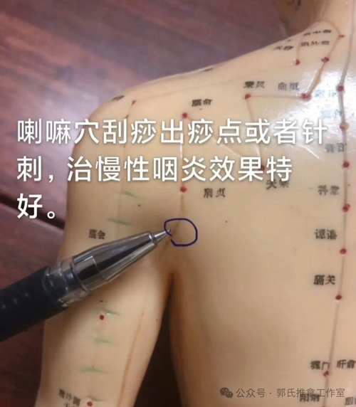 针灸治疗咽炎几天能好