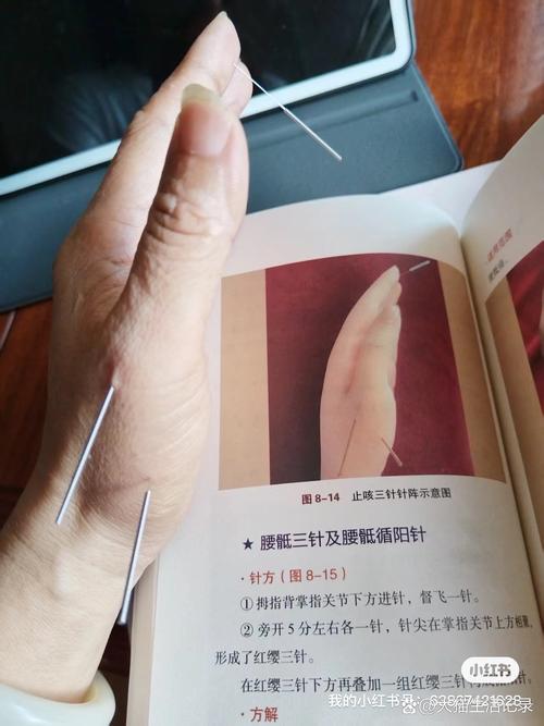 针灸引起气胸怎么治疗