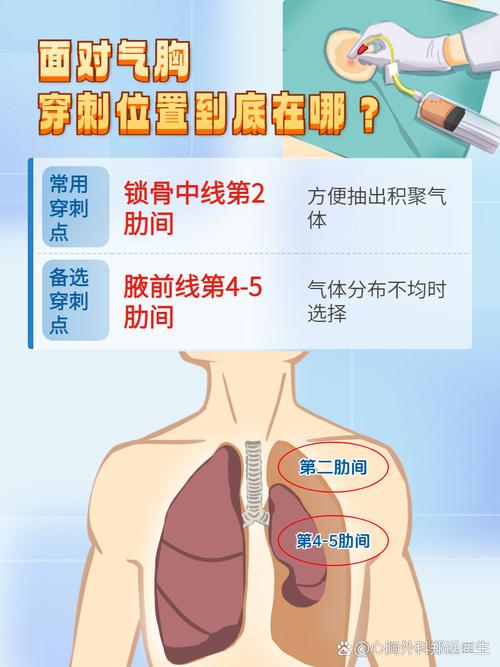 针灸引起气胸怎么治疗