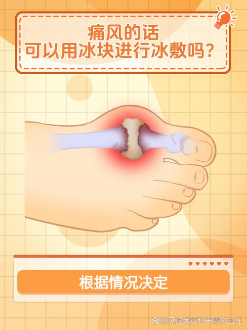 痛风可以用冰块消肿吗