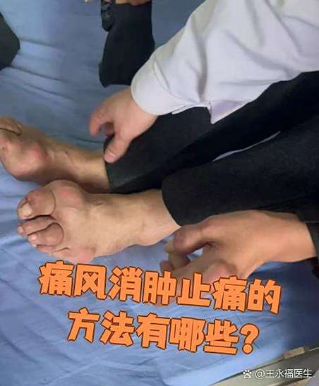 痛风可以用冰块消肿吗