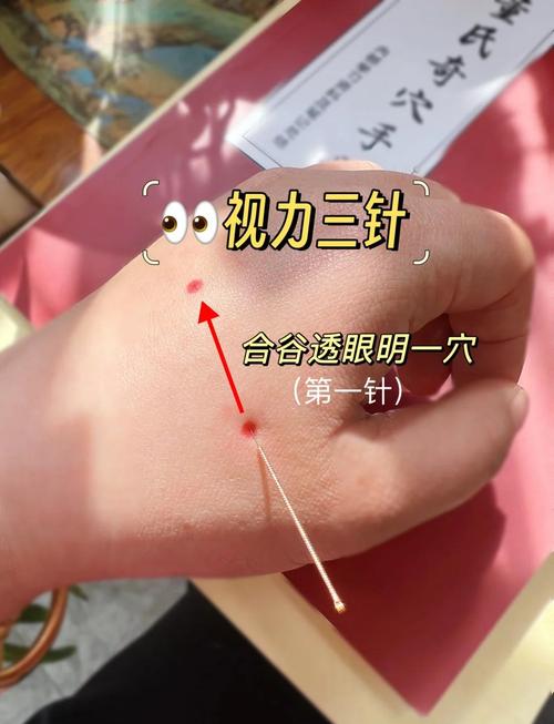 针灸对眼睛有什么好处
