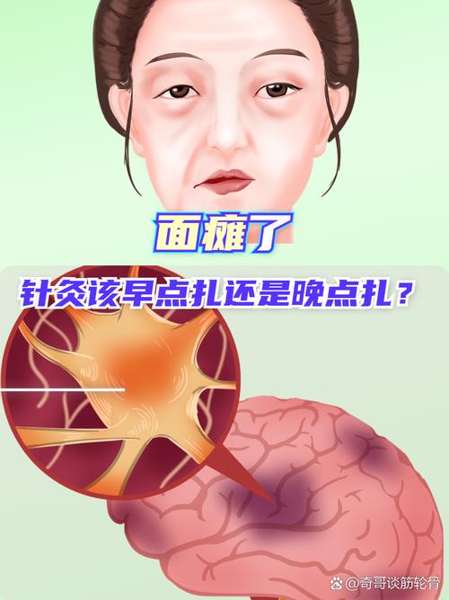 面瘫为什么不能电针灸