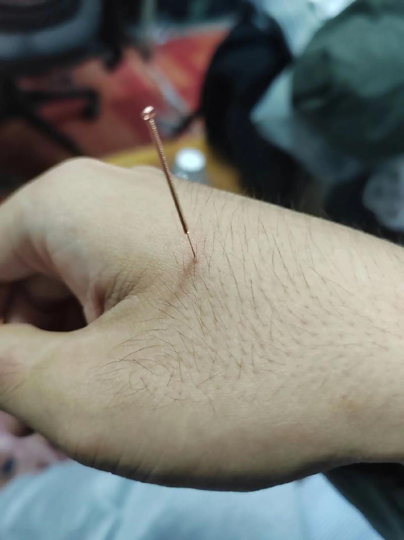 针灸后皮肤发红是有气