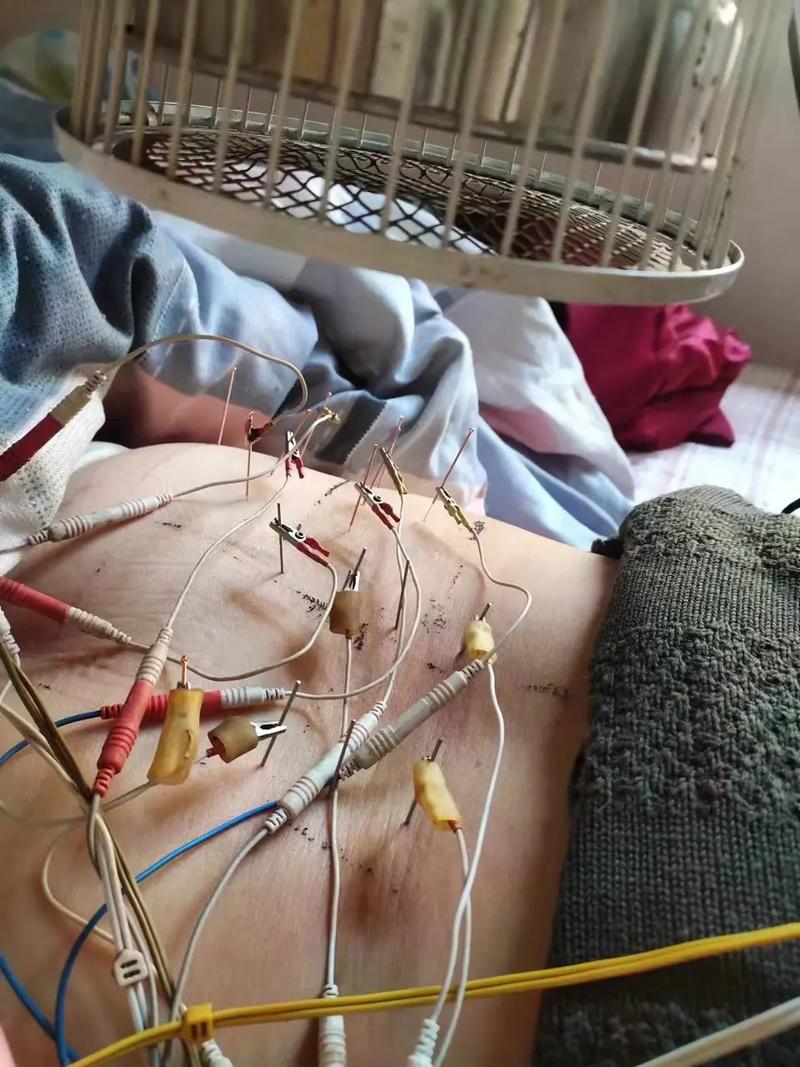 腰肌劳损针灸后更严重